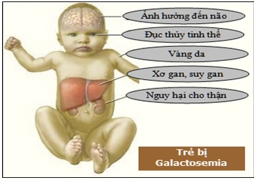 Bệnh rối loạn chuyển hóa đường Galactosemia (TGAL)